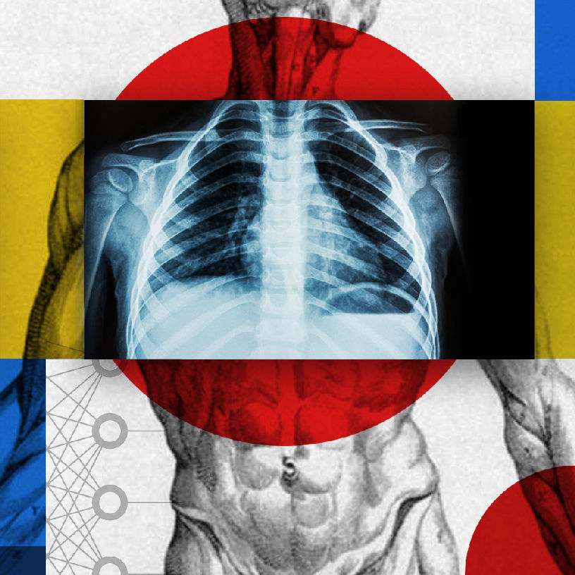 Detección de COVID 19 en radiografías de tórax